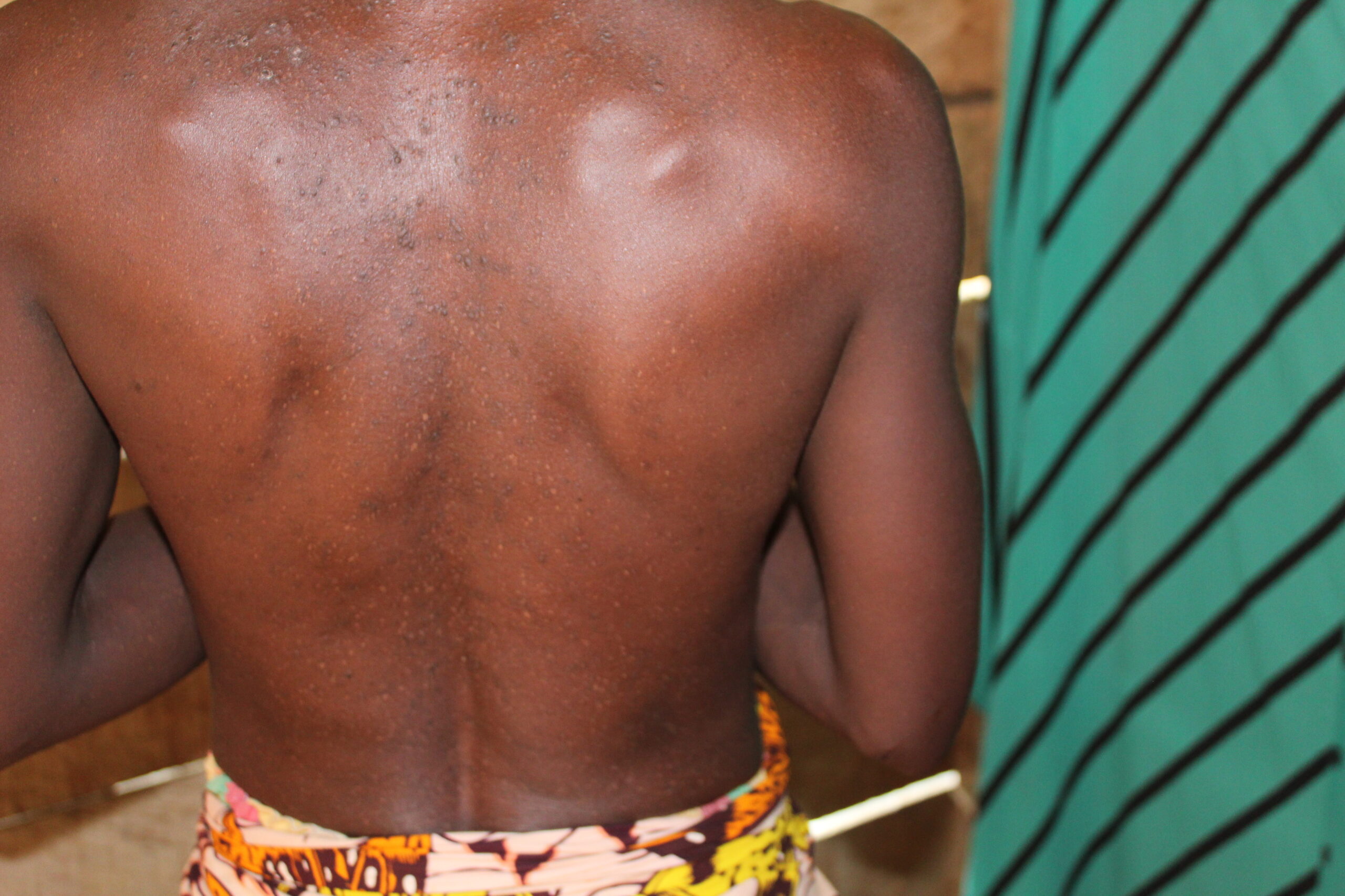 Study participant with chronic papular onchodermatitis