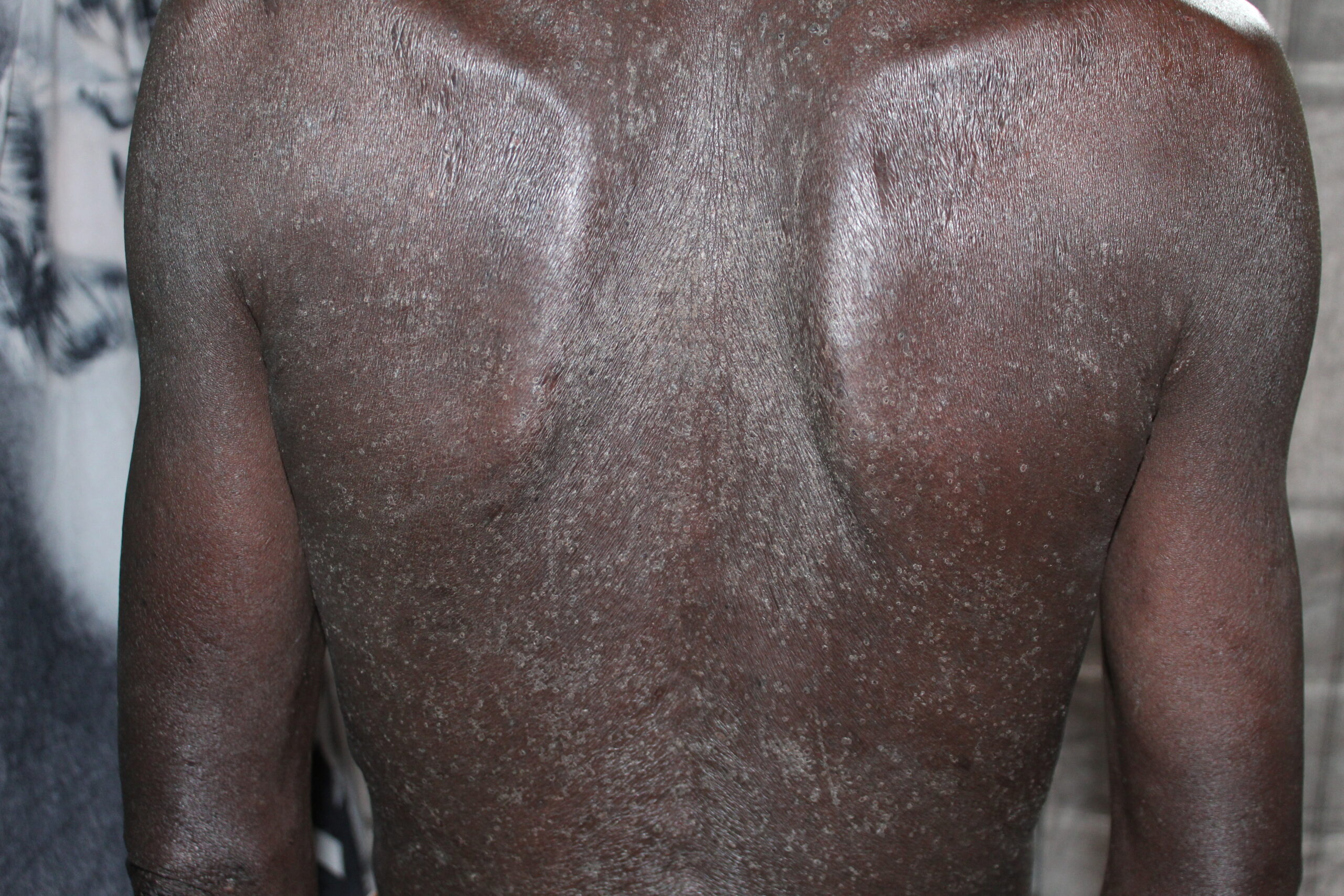 Study participant with chronic papular onchodermatitis