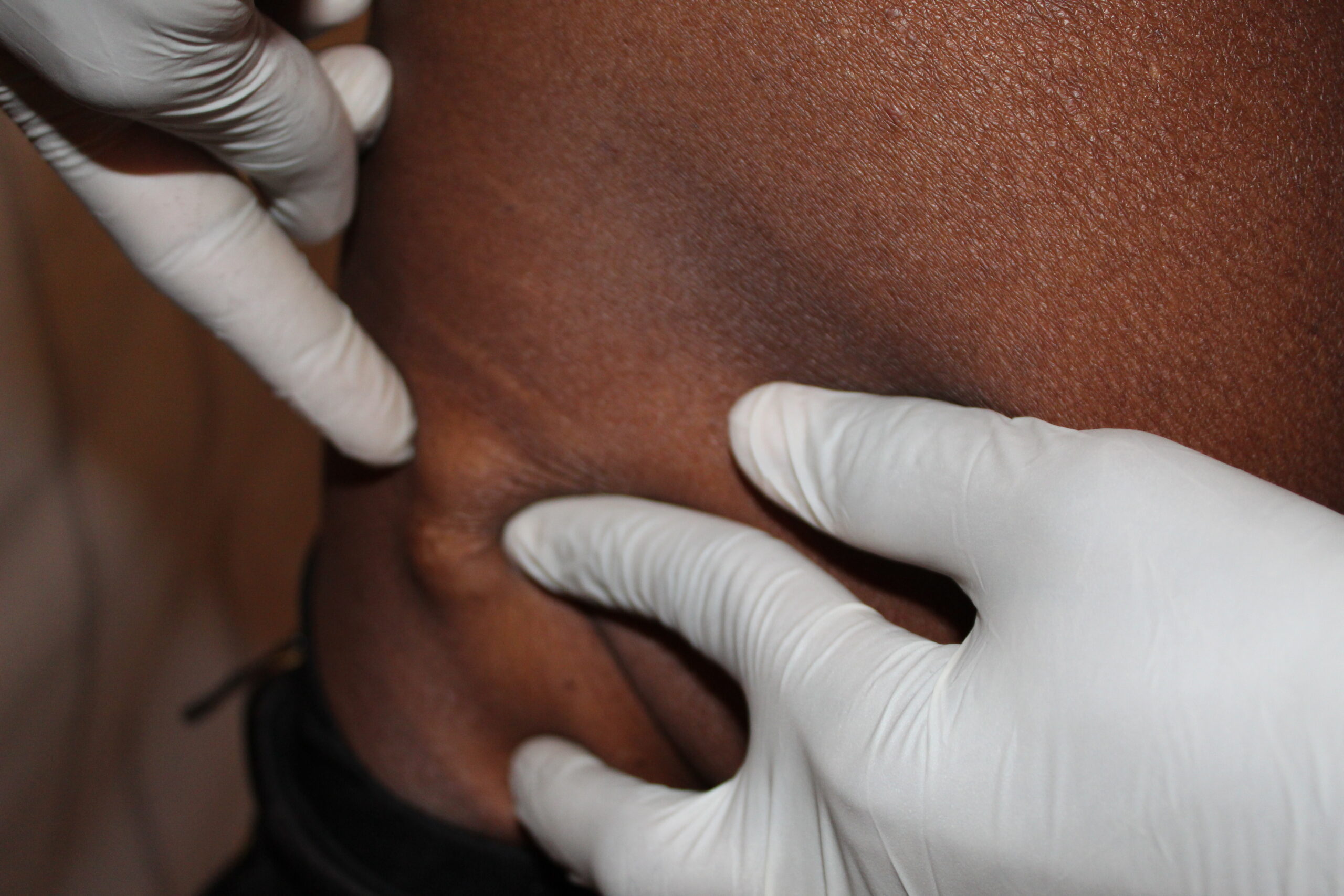 Study participant with two onchocercal nodules on the left trochanter