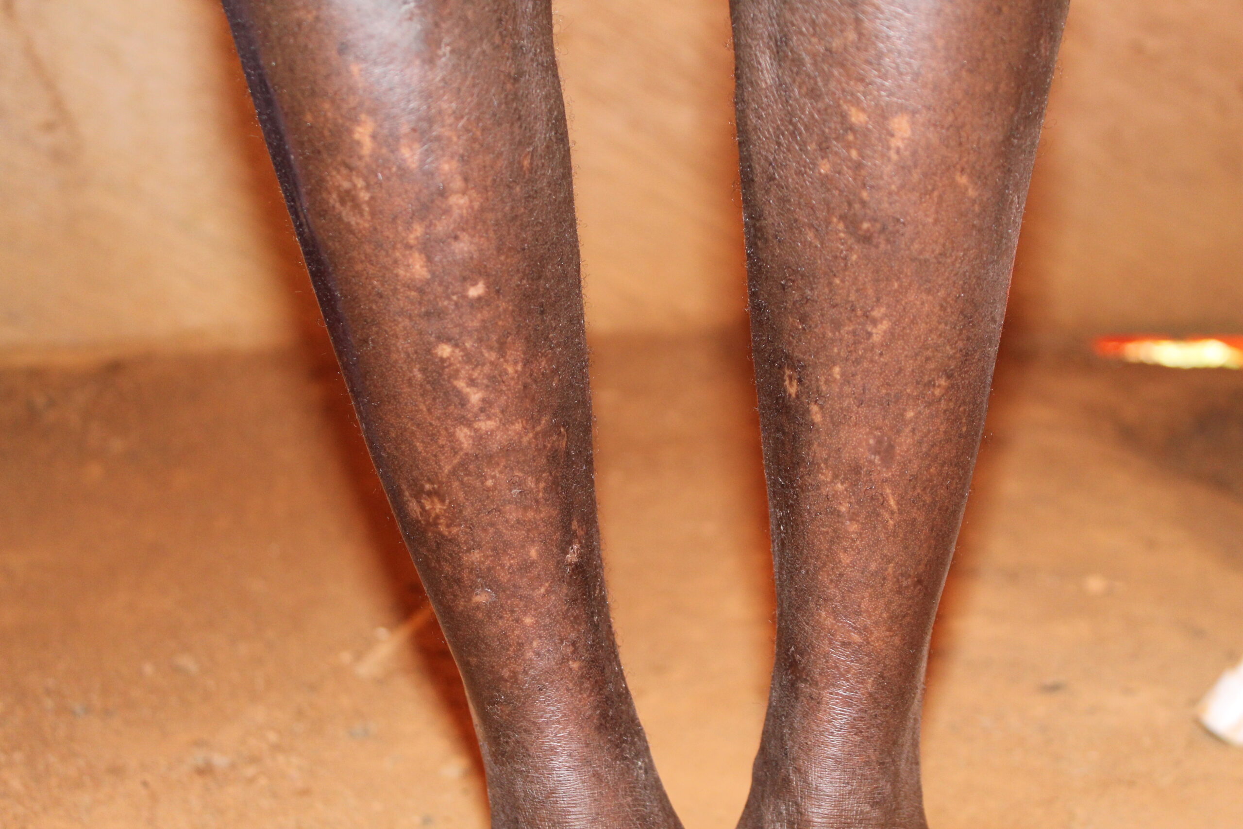 A study participant with leopard skin (depigmentation of the skin) around the shin region of the legs